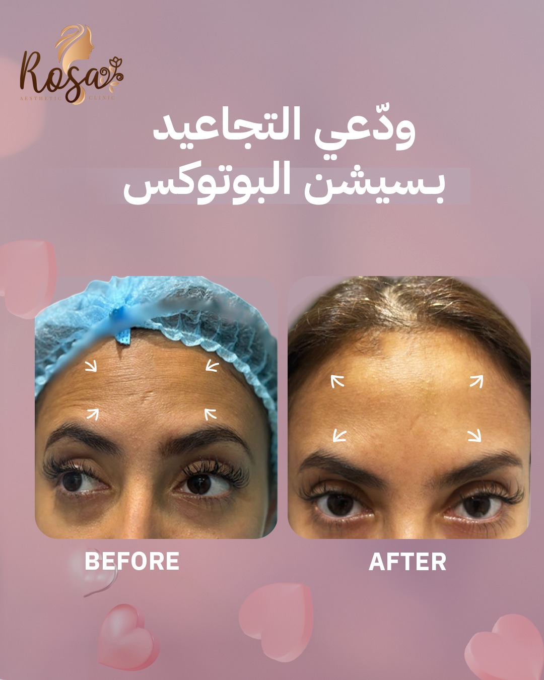 البوتوكس للتجاعيد