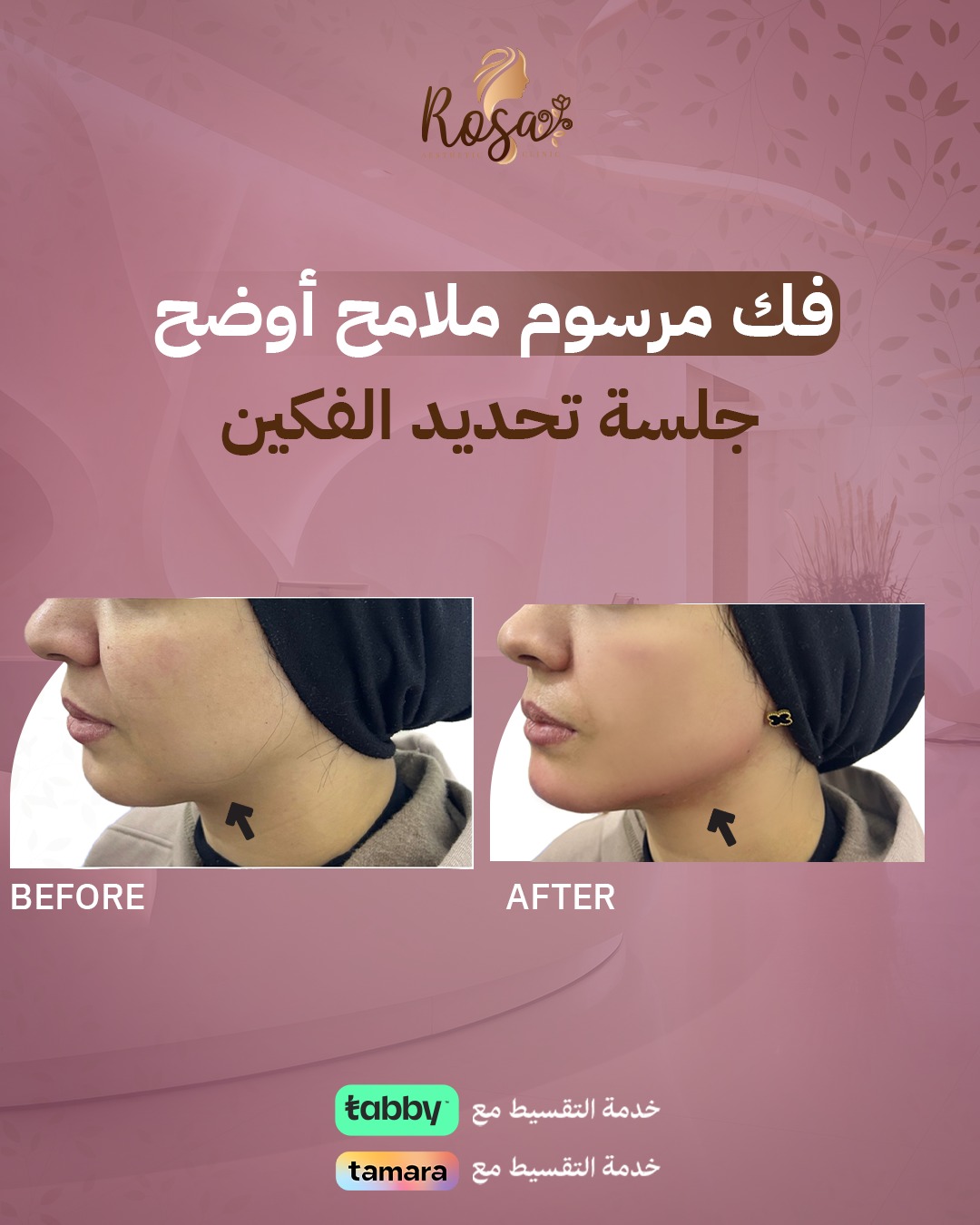 جلسة تحديد الفكين
