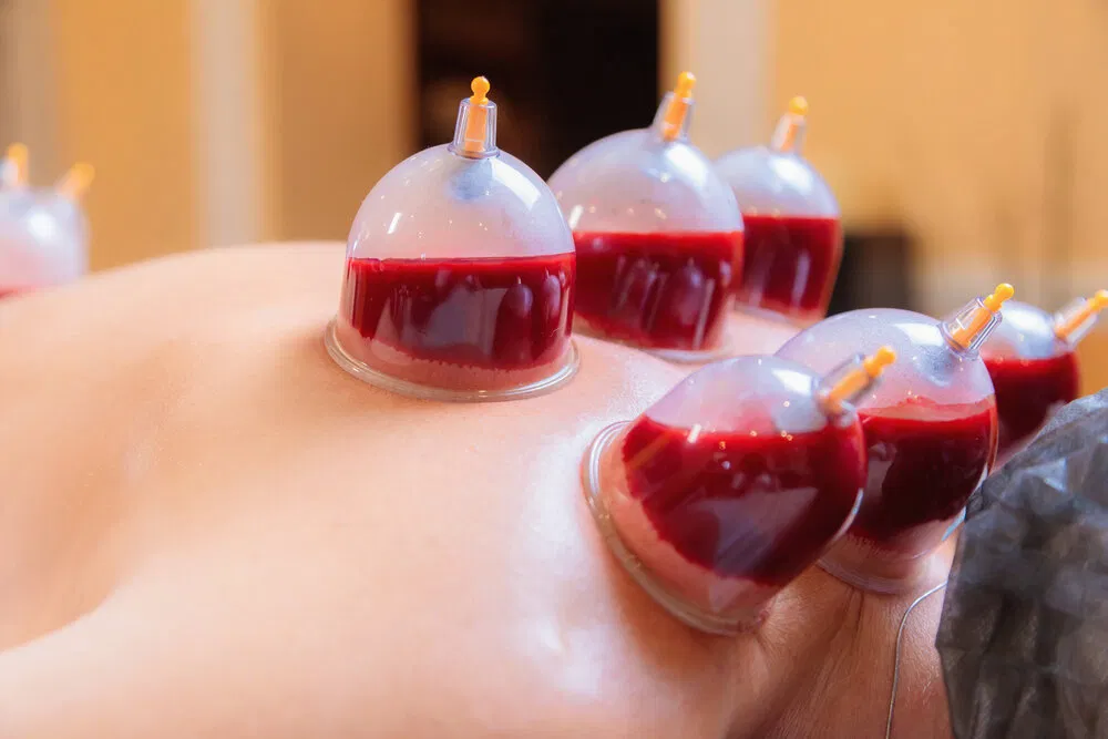 أدوات الحجامة عند النساء