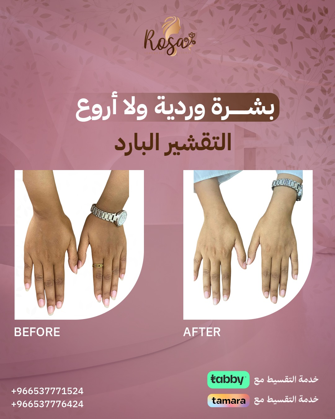 التقشير البارد