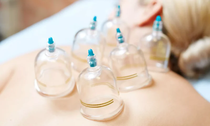عدد مرات تكرار الحجامة التجميلية للوجه