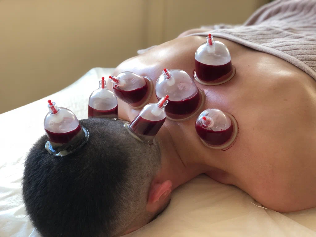 أنواع الحجامة التجميلية