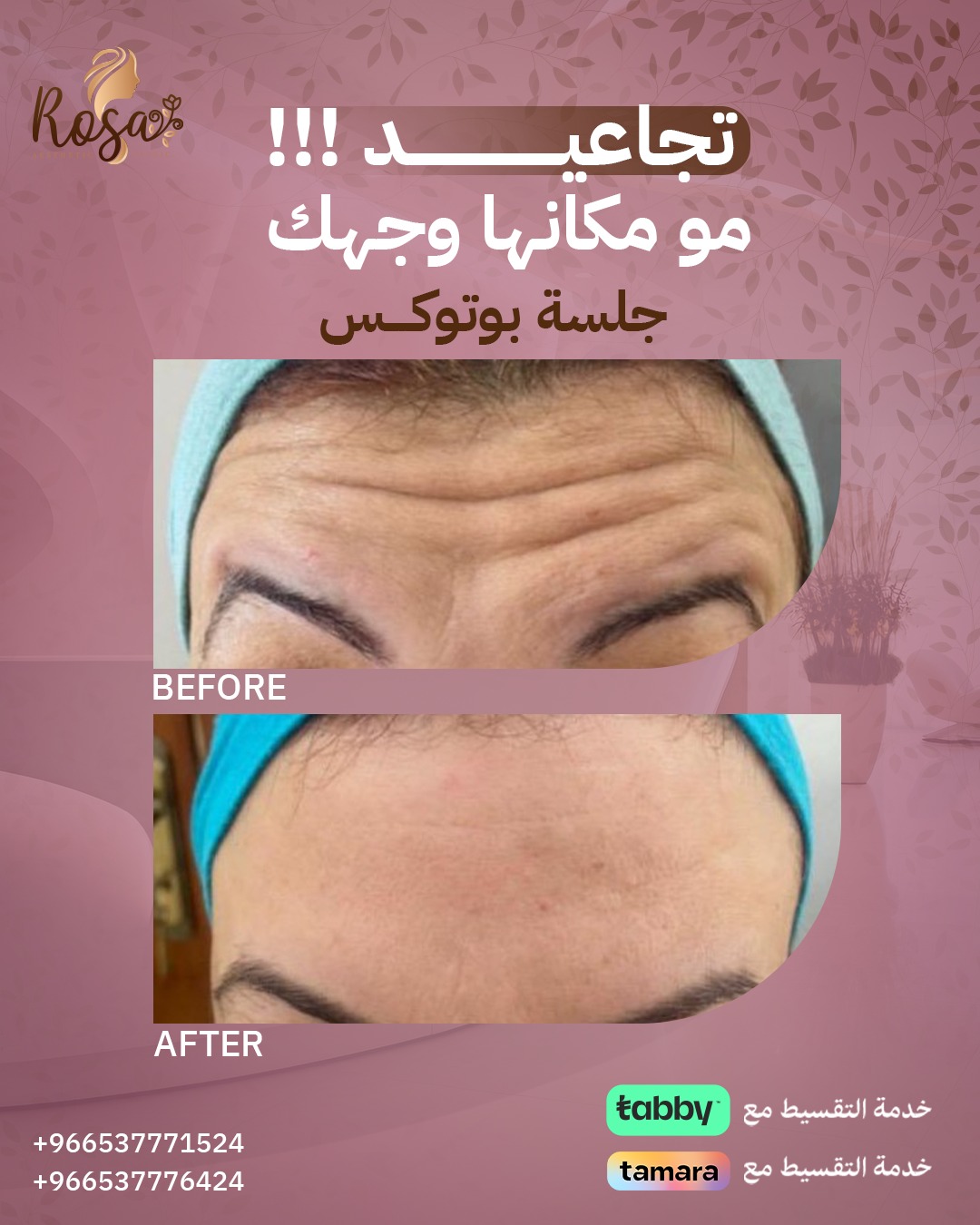 نتائج البوتوكس للوجه