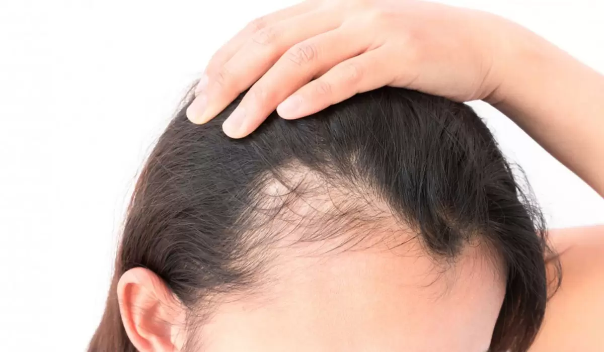 مقارنة بين علاج الشعر بالخلايا الجذعية وزراعة الشعر