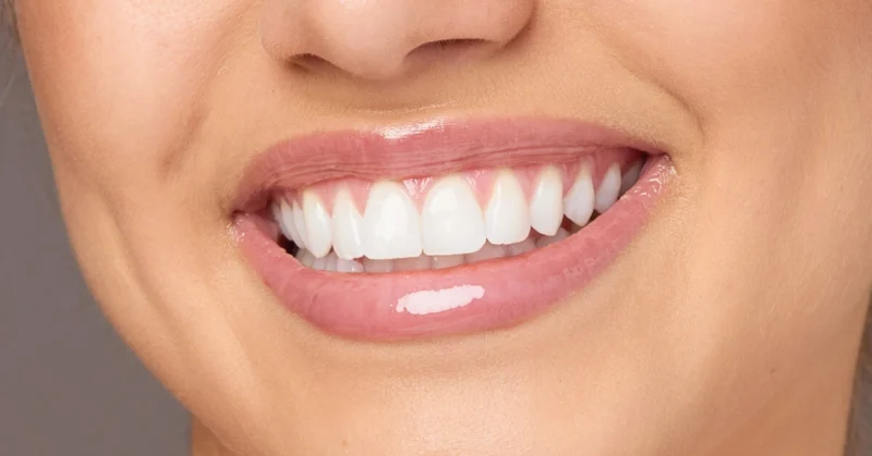 سلبيات ابتسامة هوليود